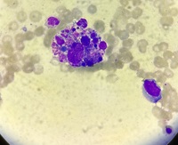 Hemophagocytosis