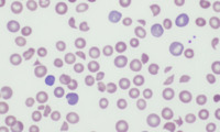 Thrombotic thrombocytopenic purpura