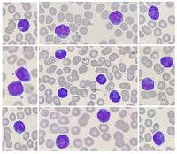 T-cell prolymphocytic leukemia (T-PLL)