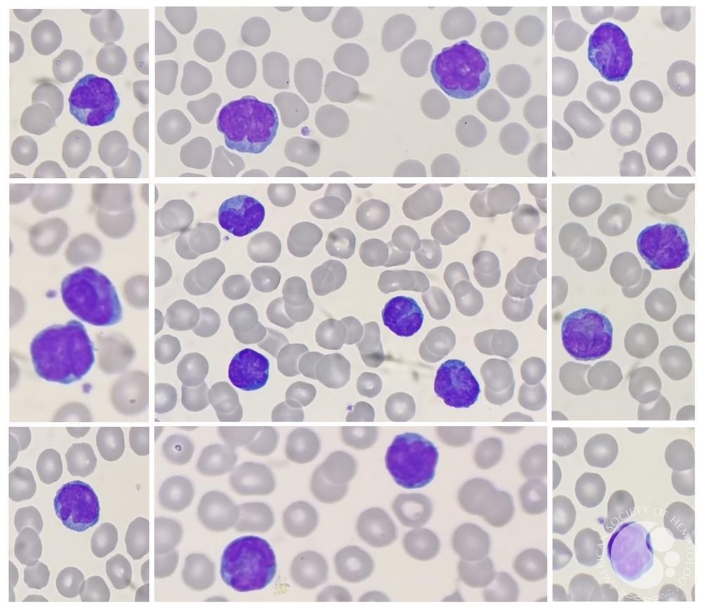 T-cell prolymphocytic leukemia (T-PLL)