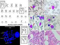 AML with t(1;11)(q21;q23)