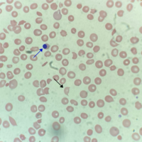 Shiga toxin 2-induced hemolytic uremic syndrome in an adult #2