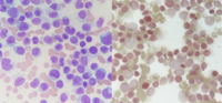 Nonspecific Sterase (NSE) in Acute Monoblastic Leukemia (AML M5)