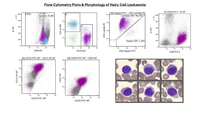 Flow Cytometry & Morphology of Hairy Cell Leukaemia (HCL)