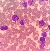 Leukemic ascites in AML with Inv 16 2