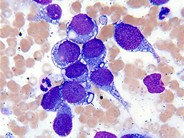 bone marrow with embryonal rhabdomyosarcoma metastasized