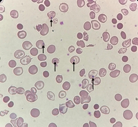 Howell-jolly bodies