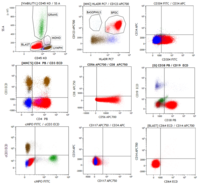 Blastic plasmacytoid dendritic cell neoplasm (BPDCN) 2