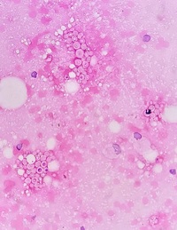 CRYPTOCOCCUS, FNAC Abdominal LN