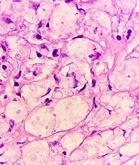 CRYPTOCOCCUS, Abdominal LN, H&E Oil immersion