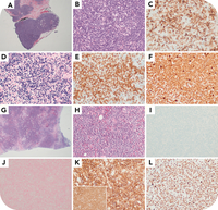 Prominent expansion of EBV large B cells obscuring follicular helper T-cell lymphoma