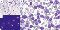 Appearances deceive: unmasking mantle cell lymphoma with prolymphocytic morphology