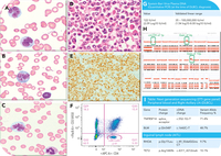 Unveiling the enigma: circulating flowerlike large B-lymphoma cells in the context of angioimmunoblastic T-cell lymphoma
