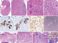 Primary myelofibrosis involving lymph nodes with the same mutational profile in bone marrow