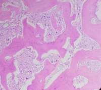 Primary myelofibrosis (PMF) with osteosclerotic progression 1