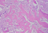 Primary myelofibrosis (PMF) with osteosclerotic progression 2