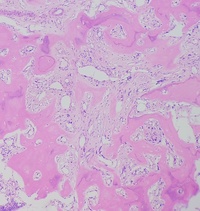 Primary myelofibrosis (PMF) with osteosclerotic progression 3