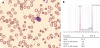 Severe oxidant hemolysis in a child with G6PD deficiency and Hb C trait