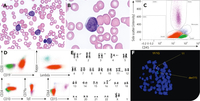 B-lymphoblastic leukemia with KMT2A rearrangement with mature B-cell phenotype and surface λ light-chain restriction