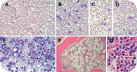 Therapy-related juvenile myelomonocytic leukemia