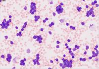 Acute Lymphoblastic Leukemia with cup-shaped blast morphology 1
