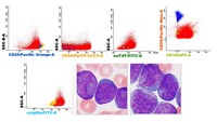 Acute Lymphoblastic Leukemia with cup-shaped blast morphology 2