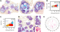 AML with mutated TP53, therapy-related, with basophilic differentiation, partial CD22, and ring sideroblasts