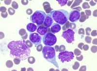 AML with PICALM::MLLT10