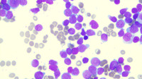 ETP-ALL bone marrow smear
