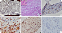 A rare case of epithelioid hemangioendothelioma involving bone marrow