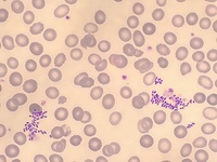 Klebsiella pneumoniae in periferal blood smear of immunocompromised patient 1