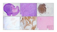 EBV-positive follicular hyperplasia in colon biopsy in a patient with HIV