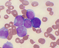 Acute Promyelocytic Leukemia (APL)