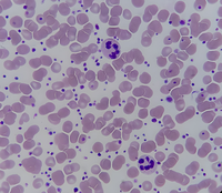 Hypersegmented Neutrophil in a Patient with Thrombocytosis