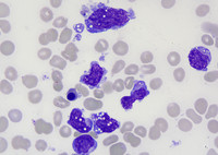 Aggressive T/NK-Cell Lymphoma With Marrow Involvement, Figure 1