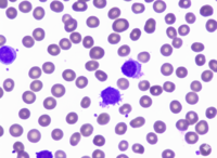 Splenic Marginal Zone Lymphoma with hairy projections