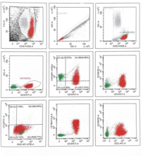 Flow cytometry in Splenic Marginal Zone Lymphoma 1