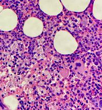 Yeast Forms in Bone Marrow Biopsy Consistent with Histoplasma