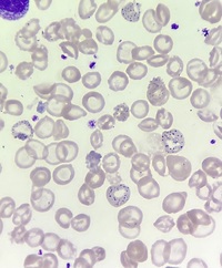 Basophilic stippling of red blood cells