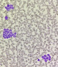 Neutrophil aggregation in sepsis