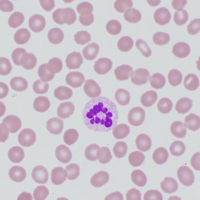 Markedly hypersegmented neutrophil in megaloblastic anemia