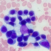 Erythroblastic island in normal bone marrow aspirate