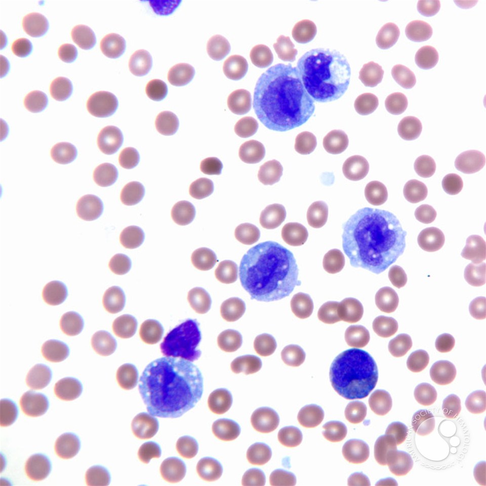 Acute monocytic leukemia - peripheral blood