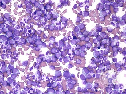 Hyperleukocytosis – CML - 1.