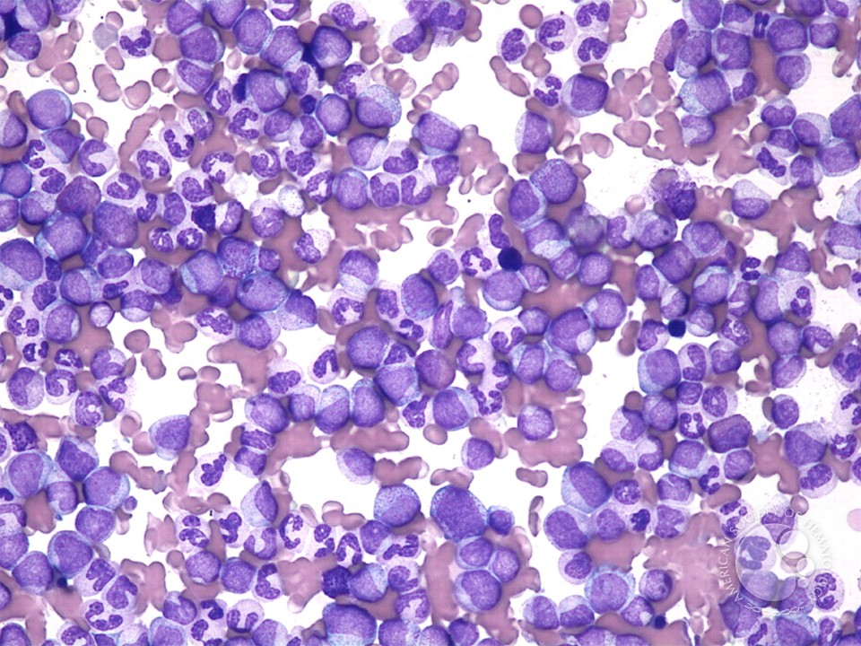 Hyperleukocytosis – CML - 1.