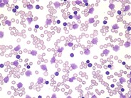 Chronic Lymphocytic Leukemia Smudge Cells