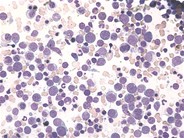 Acute erythroid leukemia - 1.
