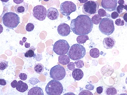 Acute erythroid leukemia - 2.