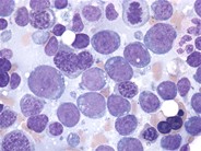 Acute erythroid leukemia - 3.