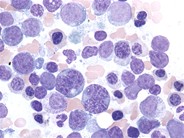 Acute erythroid leukemia - 4.